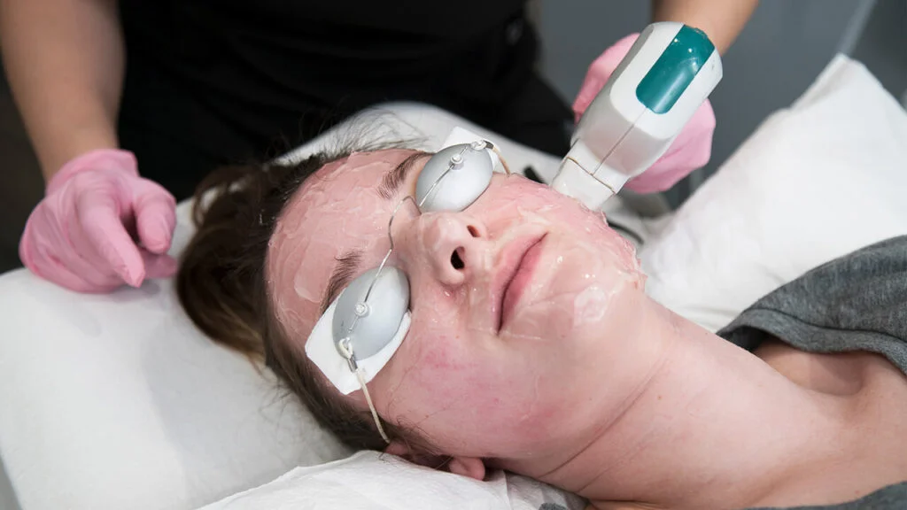 IPL Photofacial